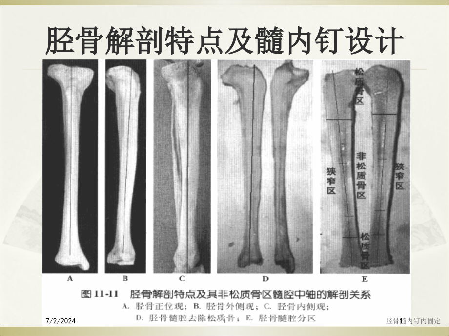 胫骨髓内钉内固定培训ppt课件_第1页