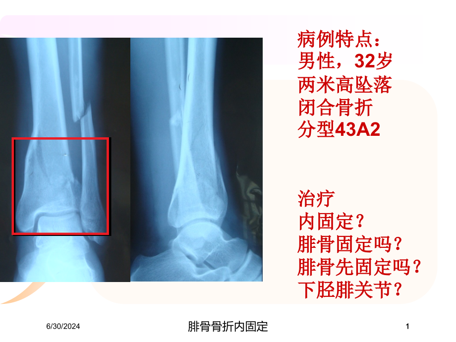 腓骨骨折内固定培训ppt课件_第1页