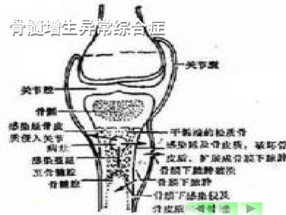 骨髓增生异常综合症课件_第1页