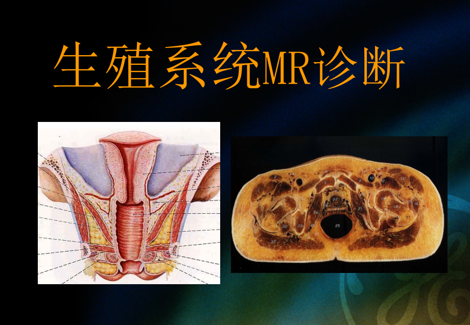 生殖系统MRI诊断课件_第1页