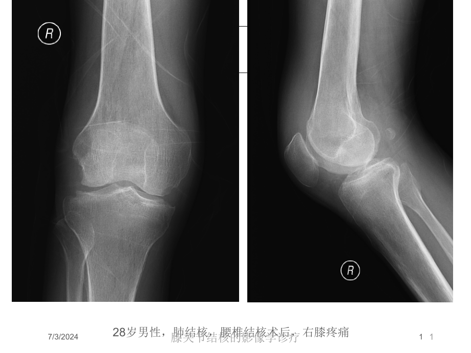 膝关节结核的影像学诊疗培训ppt课件_第1页