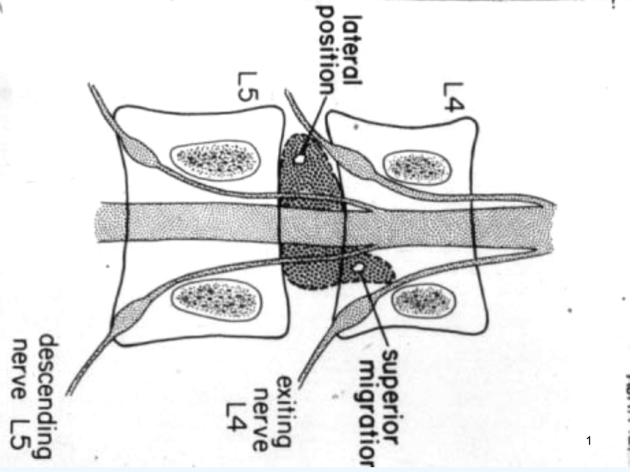腰椎间盘突出症手术图解补充文字课件_第1页