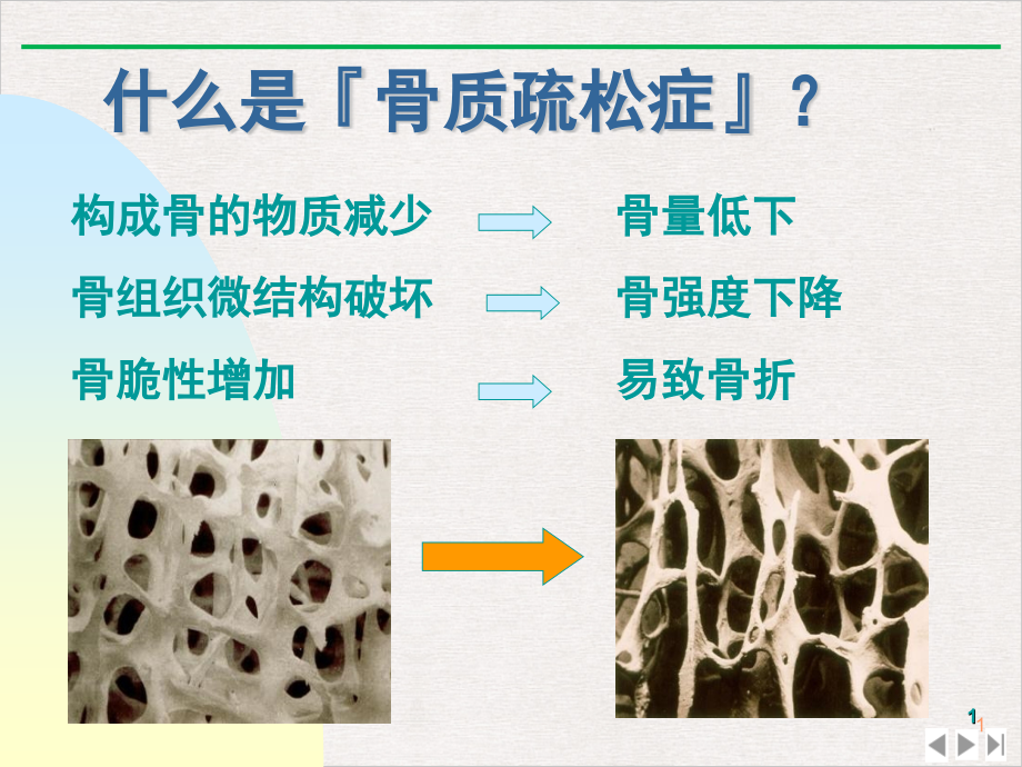 骨质疏松症了解防治课件_第1页