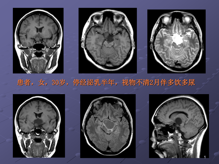 颅咽管瘤的影像诊断课件_第1页