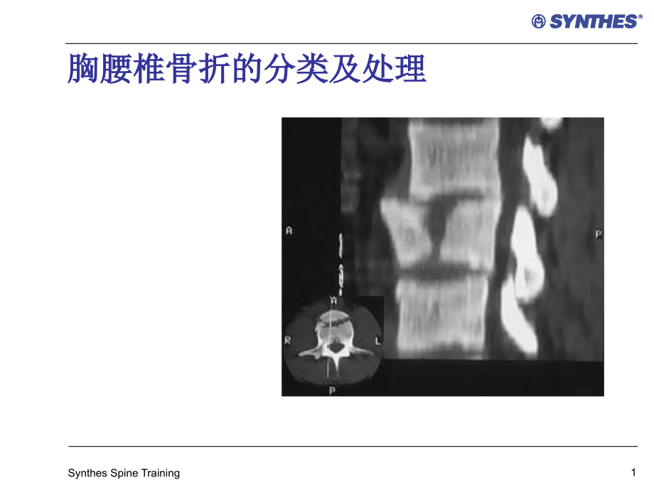 胸腰椎骨折课件_第1页