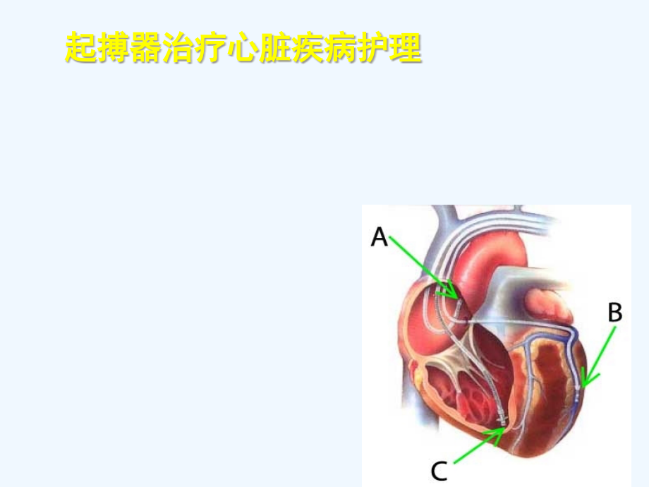 起搏器治疗心脏疾病护理课件_第1页