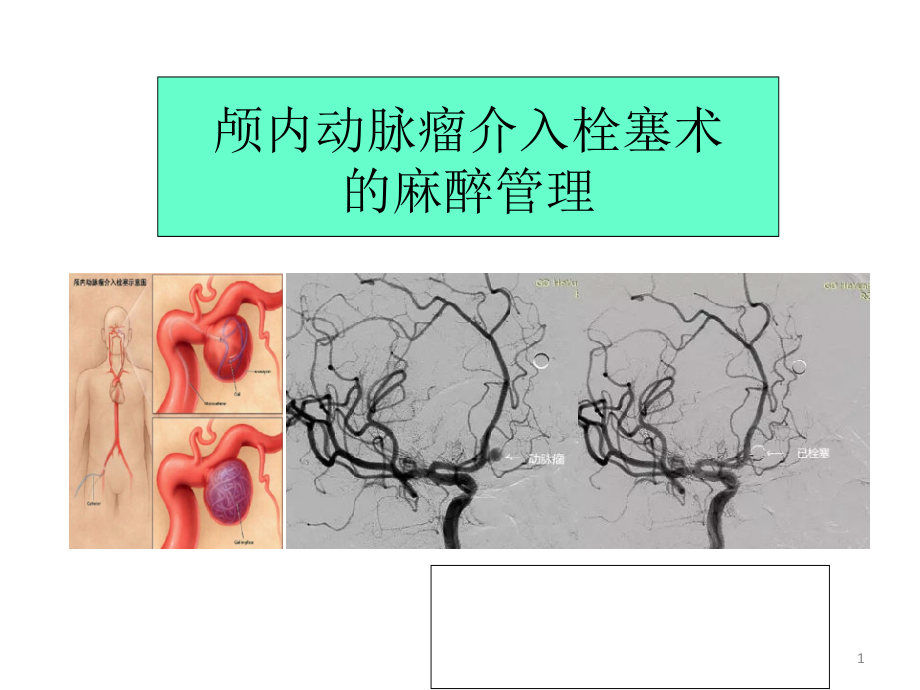 颅内动脉瘤介入栓塞术的麻醉管理课件_第1页