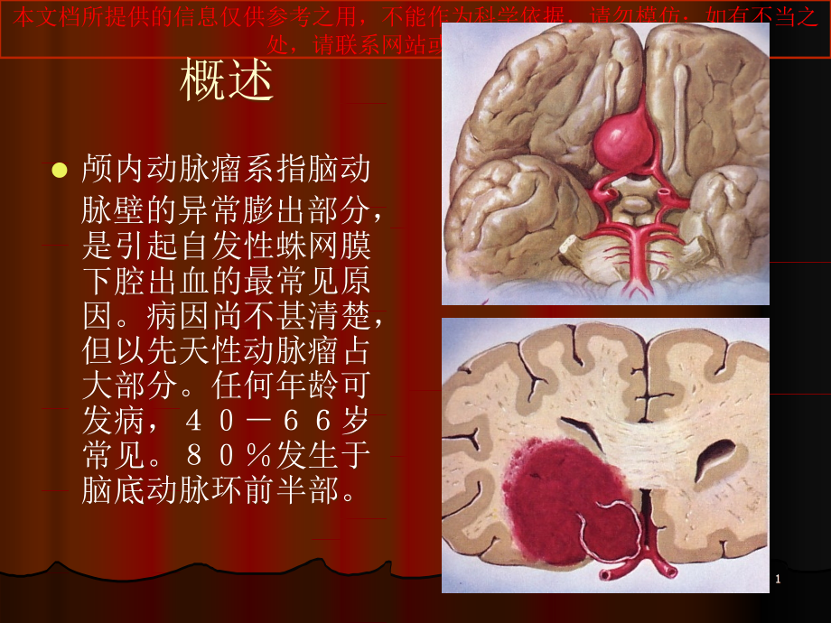 颅内动脉瘤专题医疗讲座培训ppt课件_第1页