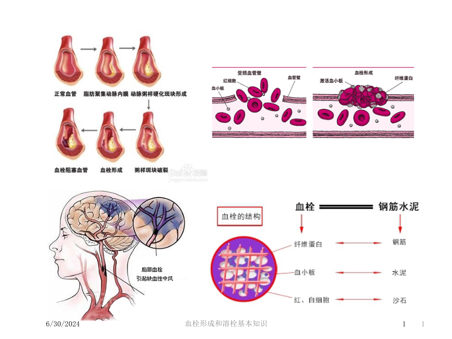 血栓形成和溶栓基本知识培训ppt课件_第1页