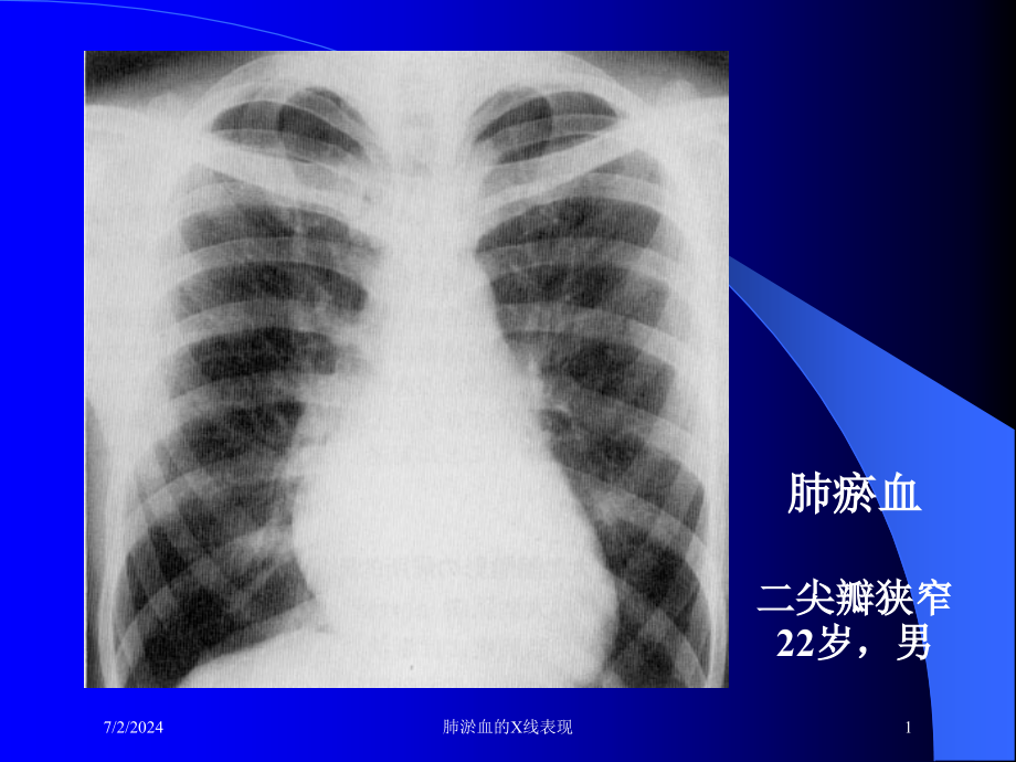 肺淤血的X线表现培训ppt课件_第1页