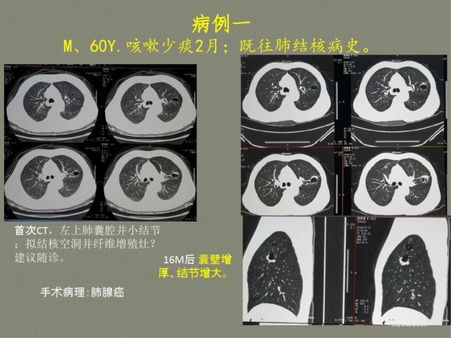 薄壁囊腔型肺癌的影像诊断和鉴别诊断liu课件_第1页