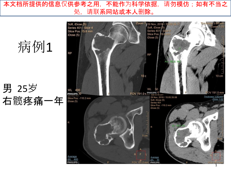 软骨母细胞瘤培训ppt课件_第1页