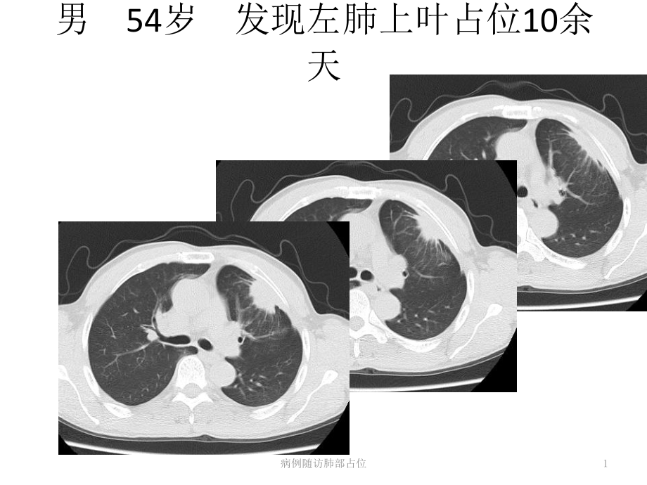 病例随访肺部占位课件_第1页