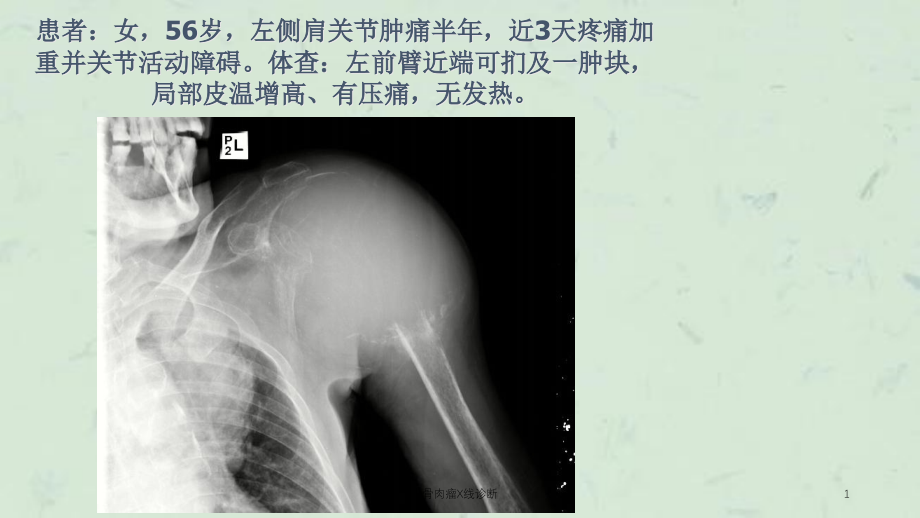 骨肉瘤X线诊断ppt课件_第1页