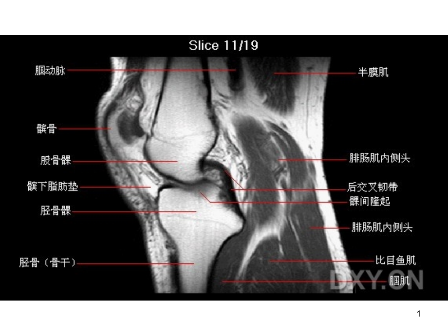 骨科膝关节的核磁共振影像课件_第1页