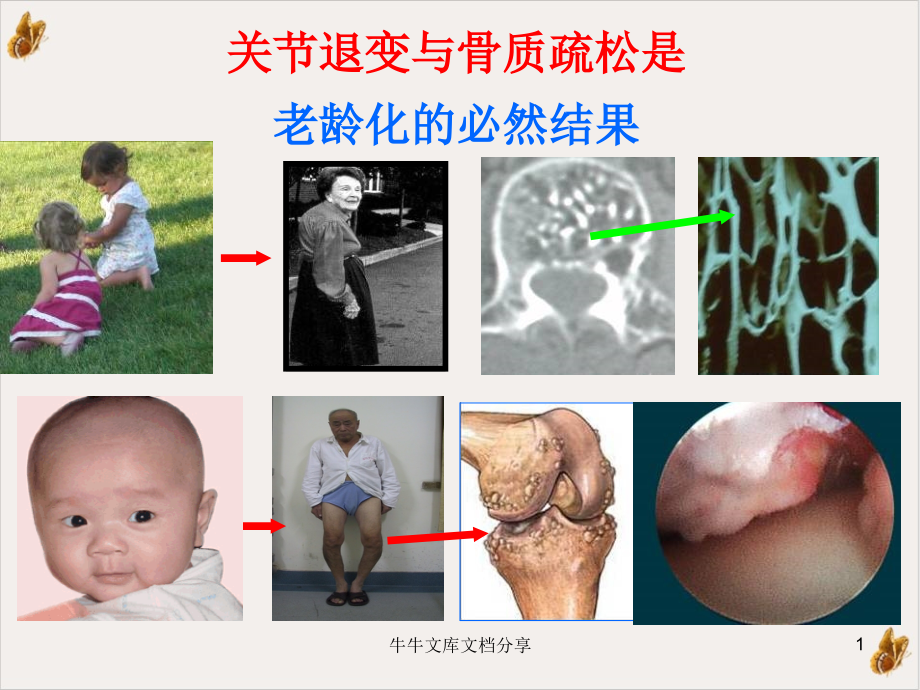 骨关节炎的阶梯治疗教材课件_第1页