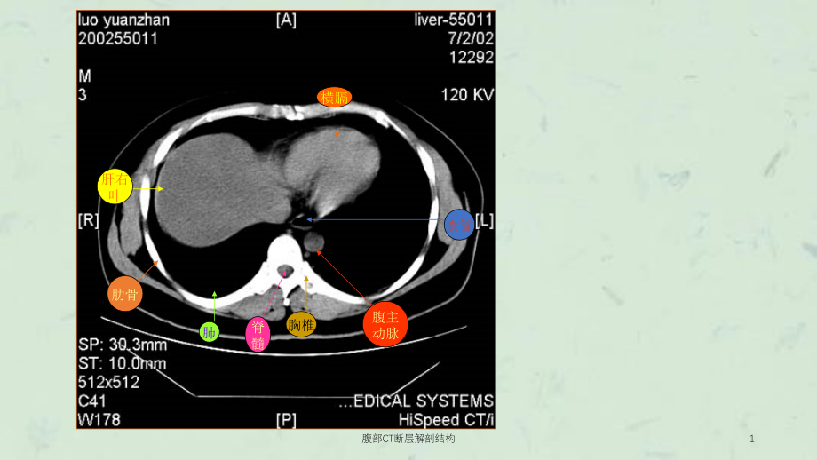 腹部CT断层解剖结构ppt课件_第1页