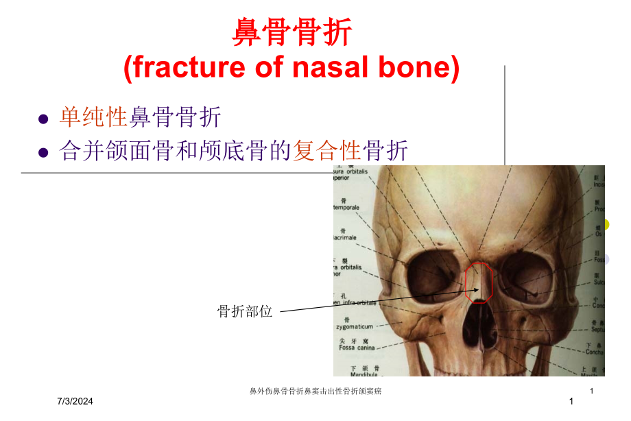 鼻外伤鼻骨骨折鼻窦击出性骨折颌窦癌培训ppt课件_第1页