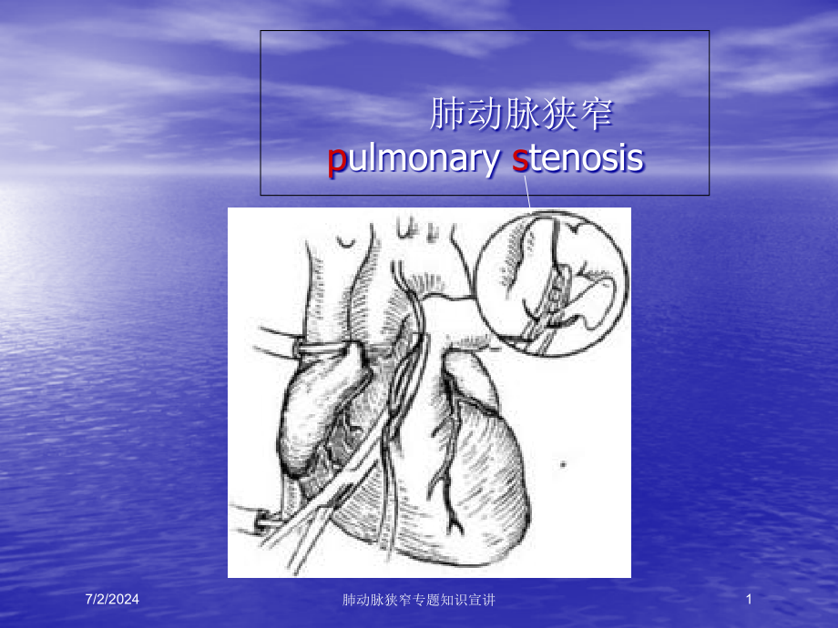 肺动脉狭窄专题知识宣讲培训ppt课件_第1页