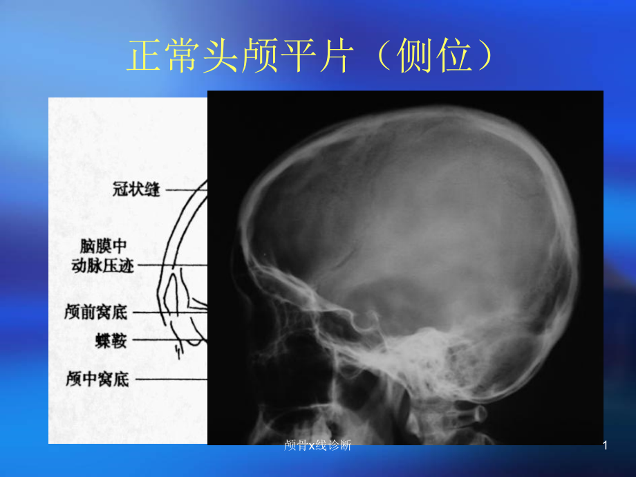 颅骨x线诊断ppt课件_第1页