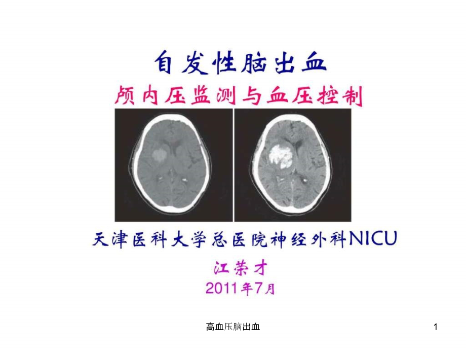 高血压脑出血ppt课件_第1页