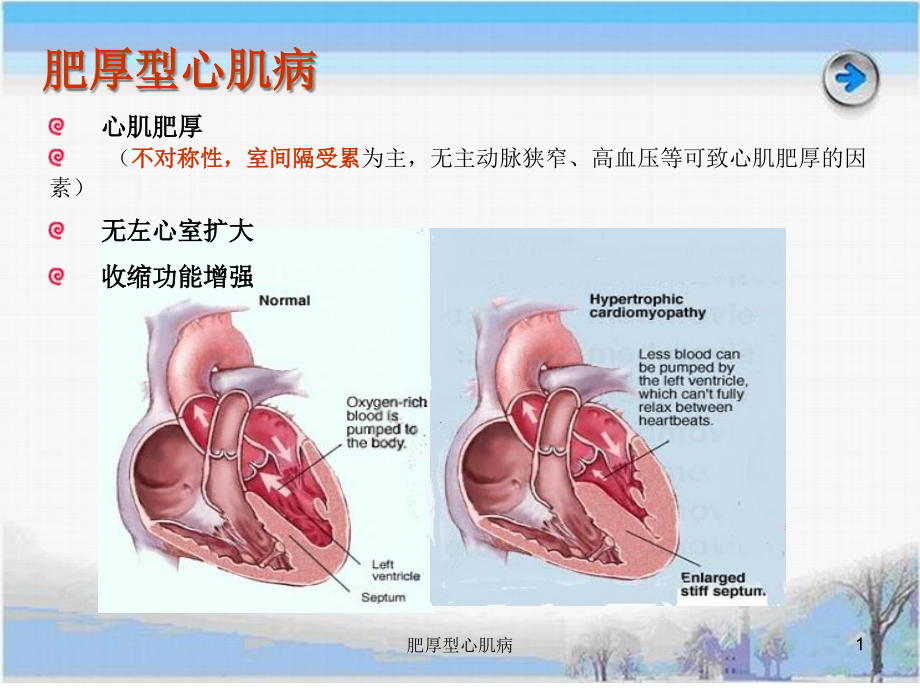 肥厚型心肌病ppt课件_第1页