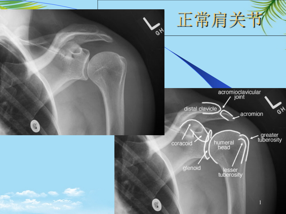 骨科常见疾病的X线表现课件_第1页