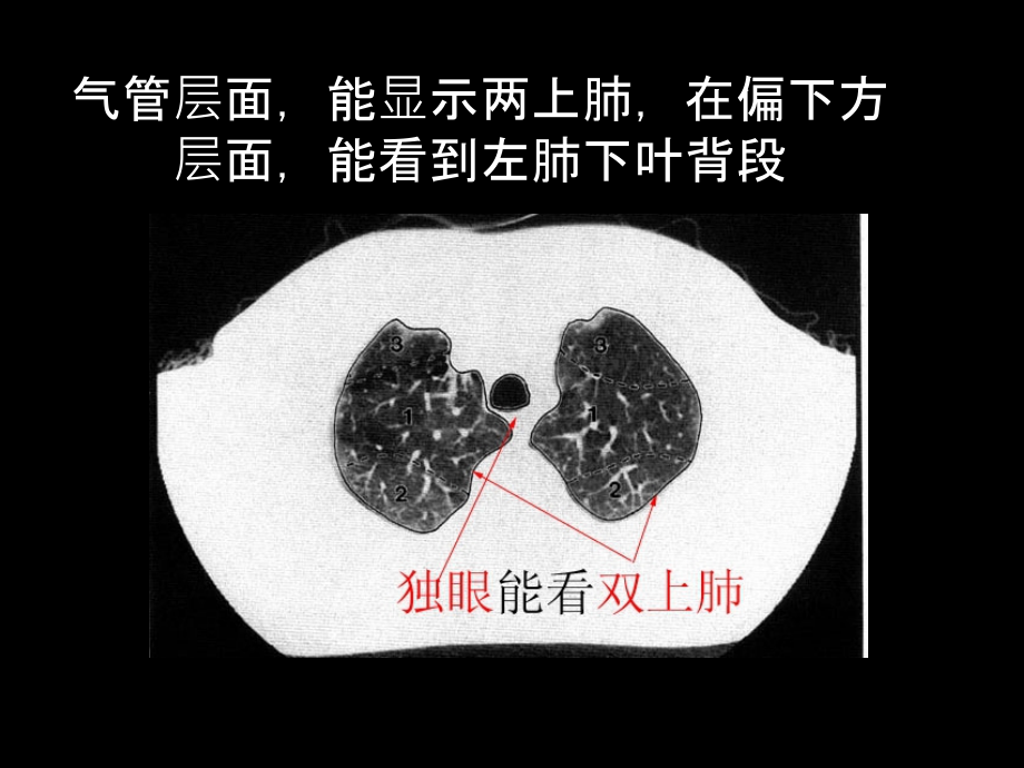 肺部CT分段课件_第1页