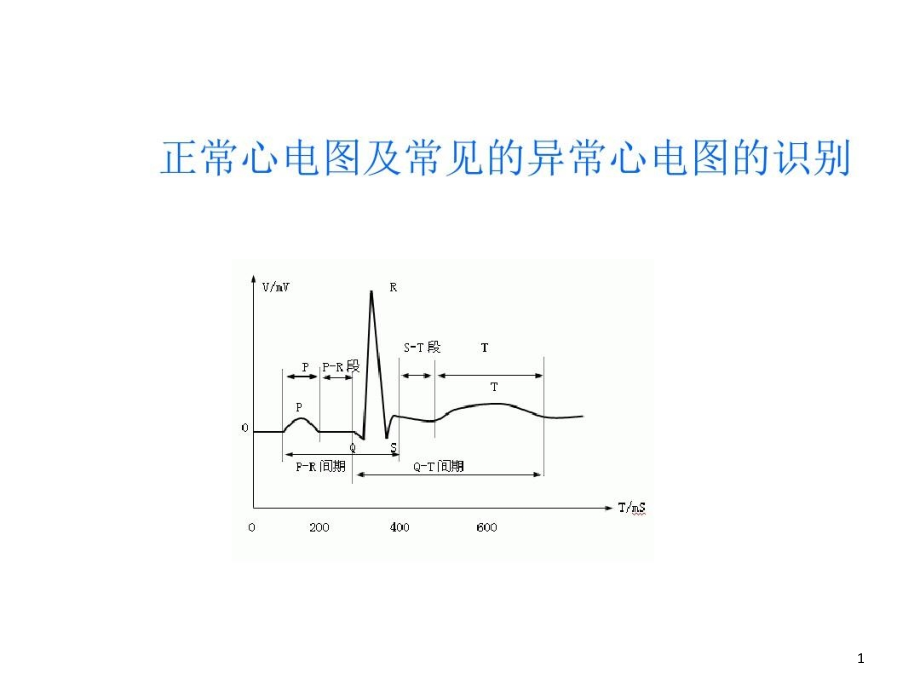 正常心电图及常见的异常心电图的识别课件_第1页