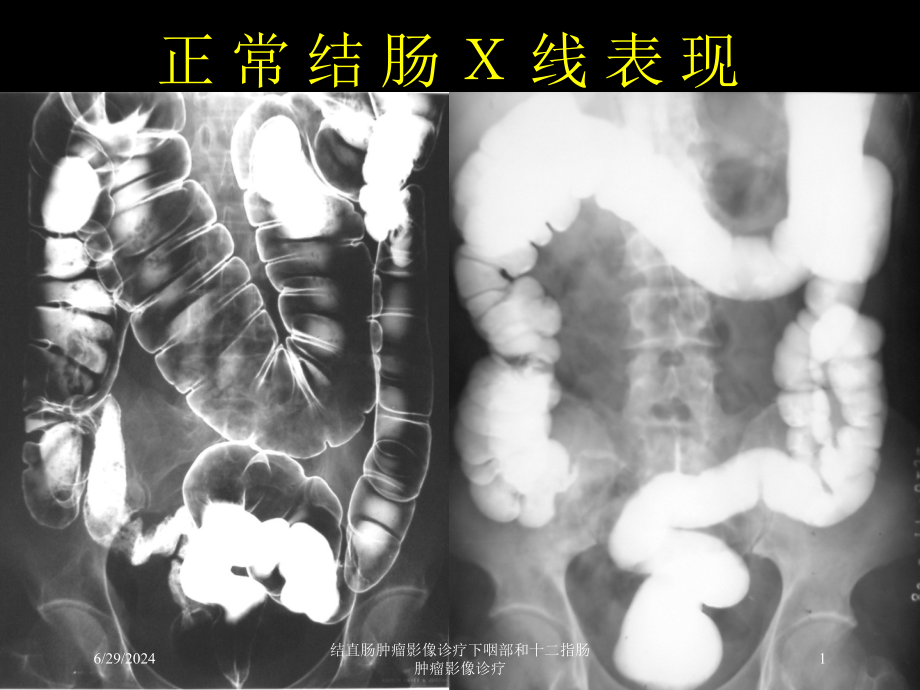 结直肠肿瘤影像诊疗下咽部和十二指肠肿瘤影像诊疗培训ppt课件_第1页