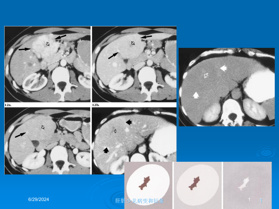 肝脏少见病变和征象培训ppt课件_第1页