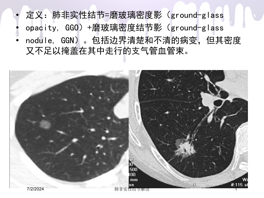 肺非实性结节解读培训ppt课件_第1页