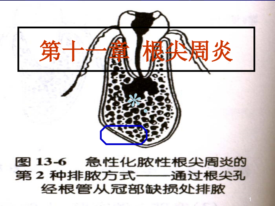 根尖周炎课件_第1页