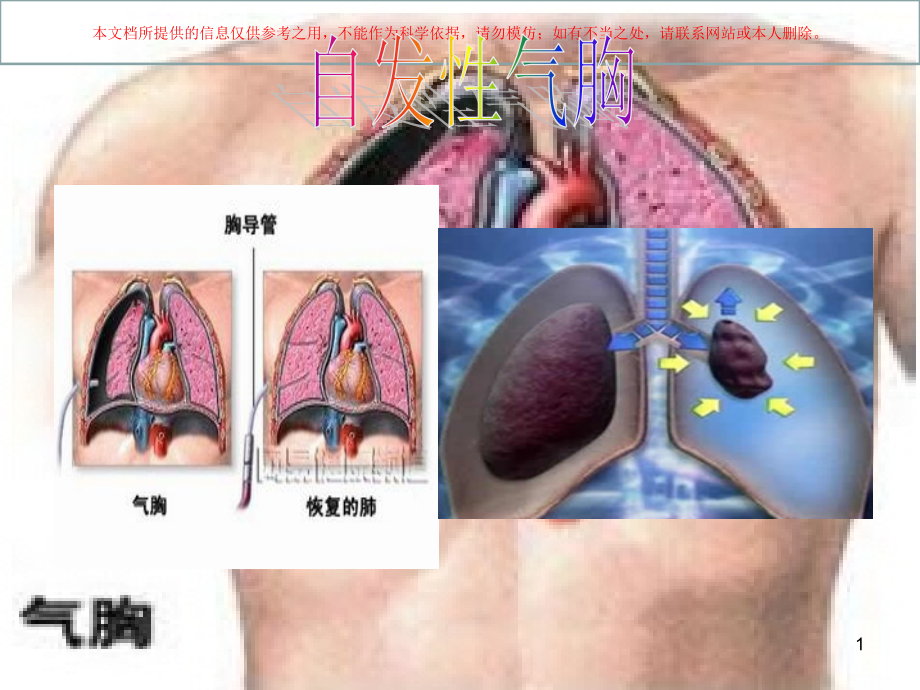 自发性气胸专业知识讲座培训ppt课件_第1页