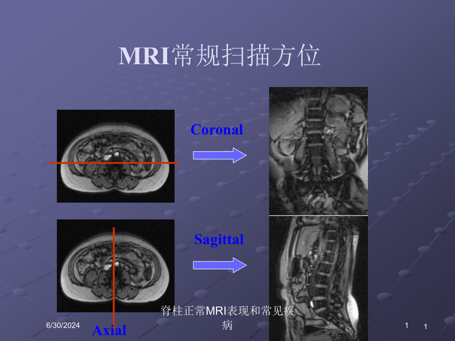 脊柱正常MRI表现和常见疾病培训ppt课件_第1页