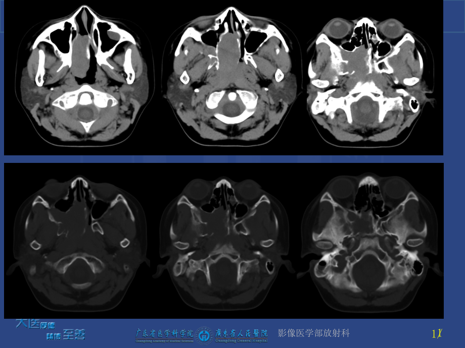 鼻咽纤维血管瘤ppt课件_第1页