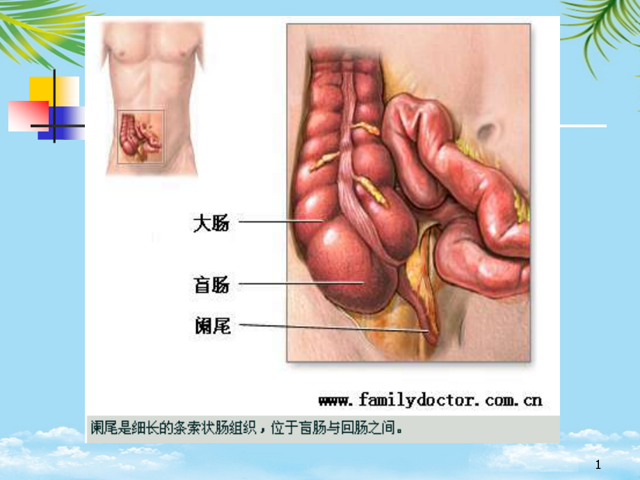 阑尾炎病人的护理本科课件_第1页