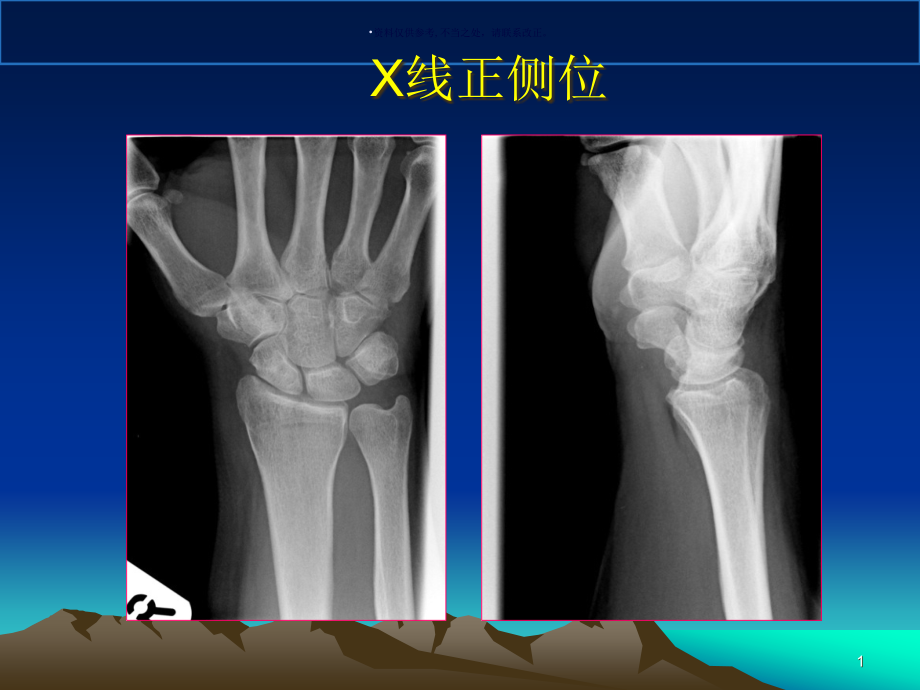 腕关节MR医学宣教课件_第1页