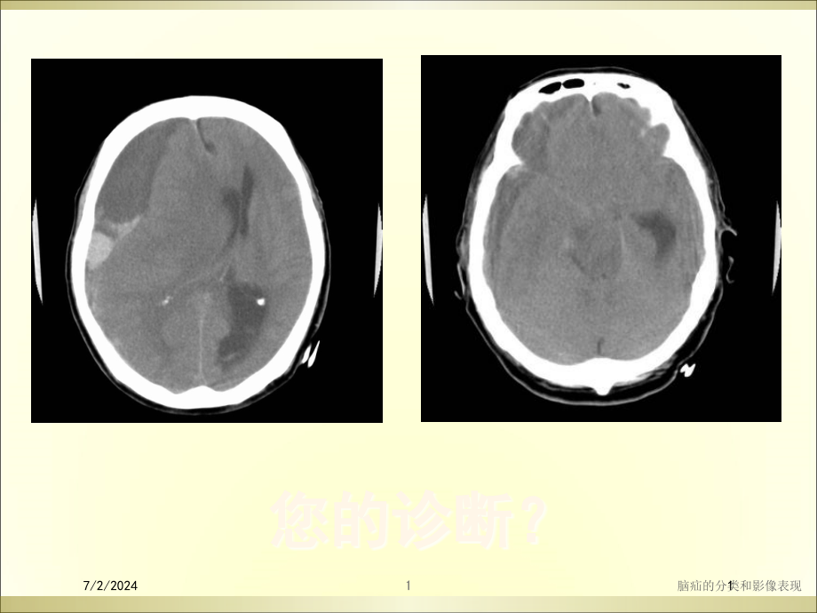 脑疝的分类和影像表现培训ppt课件_第1页