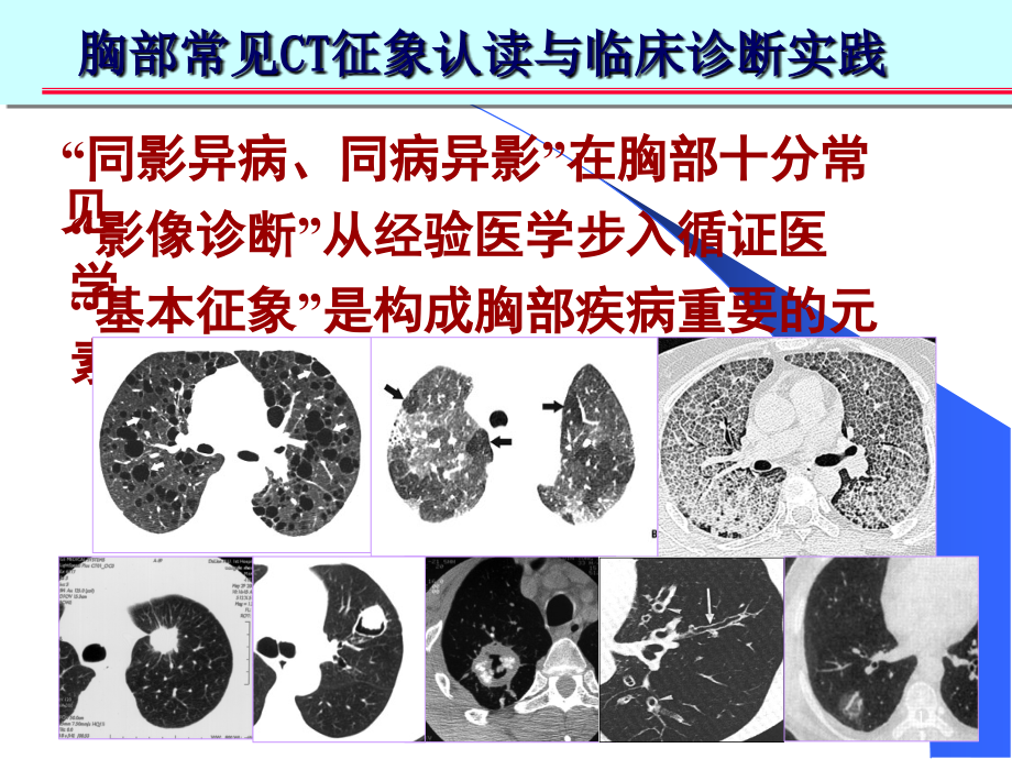 肺部CT十大征象诊断应用培训ppt课件_第1页