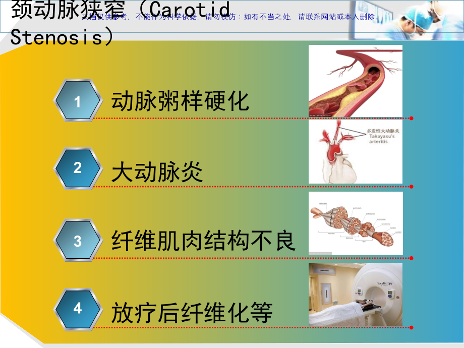 颈动脉内膜剥脱术麻醉ppt课件_第1页