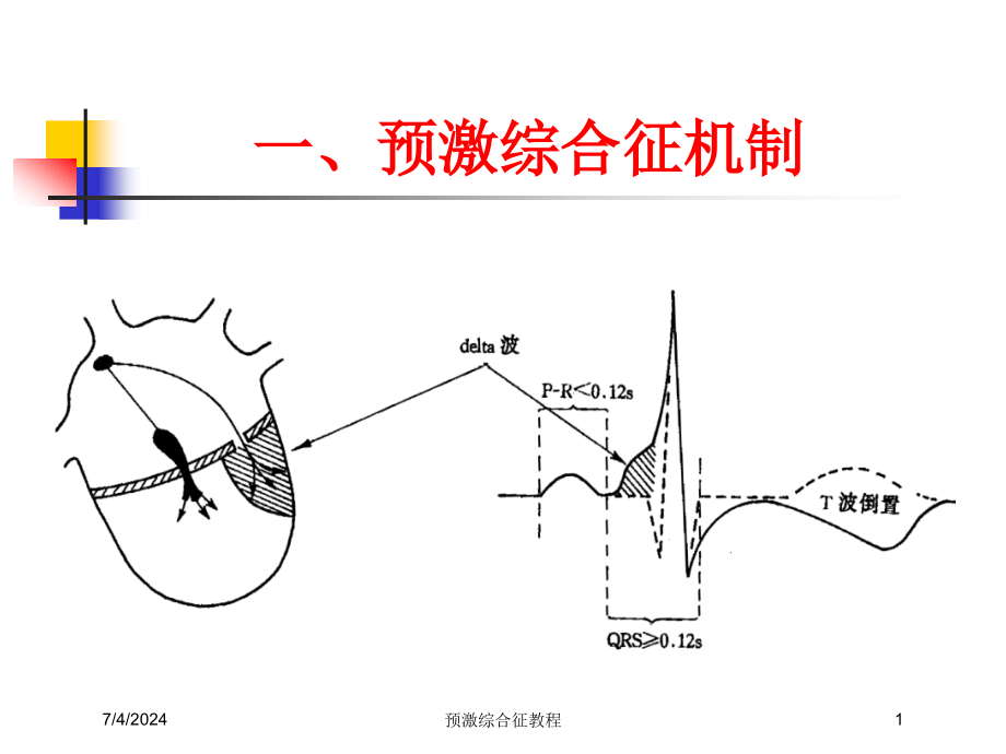 预激综合征教程培训ppt课件_第1页