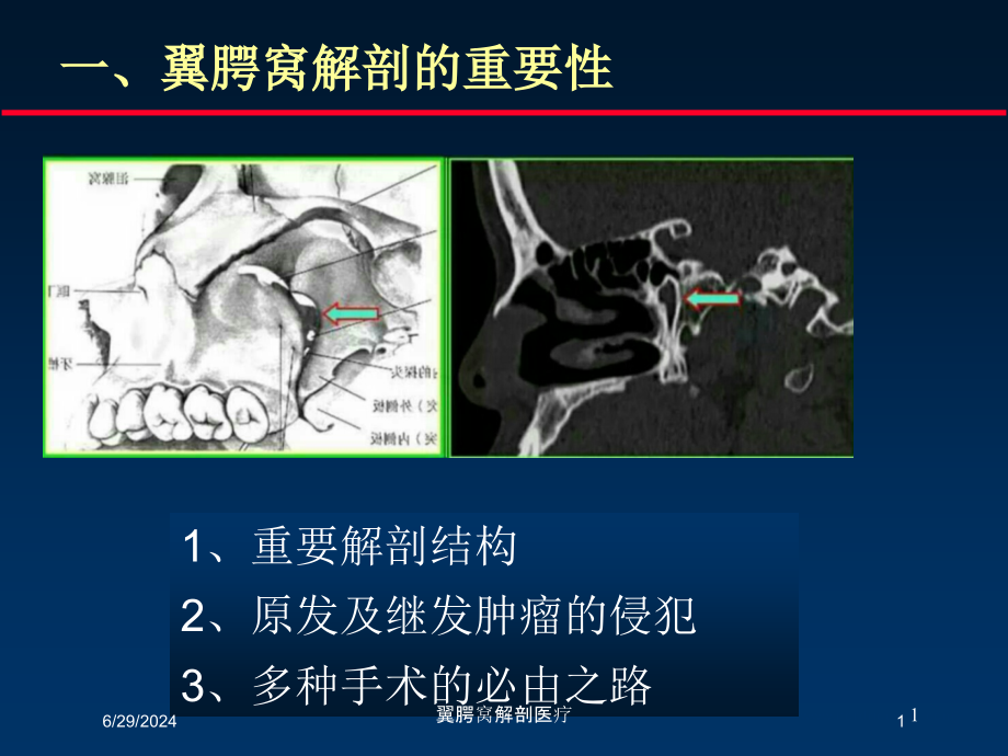 翼腭窝解剖医疗培训ppt课件_第1页