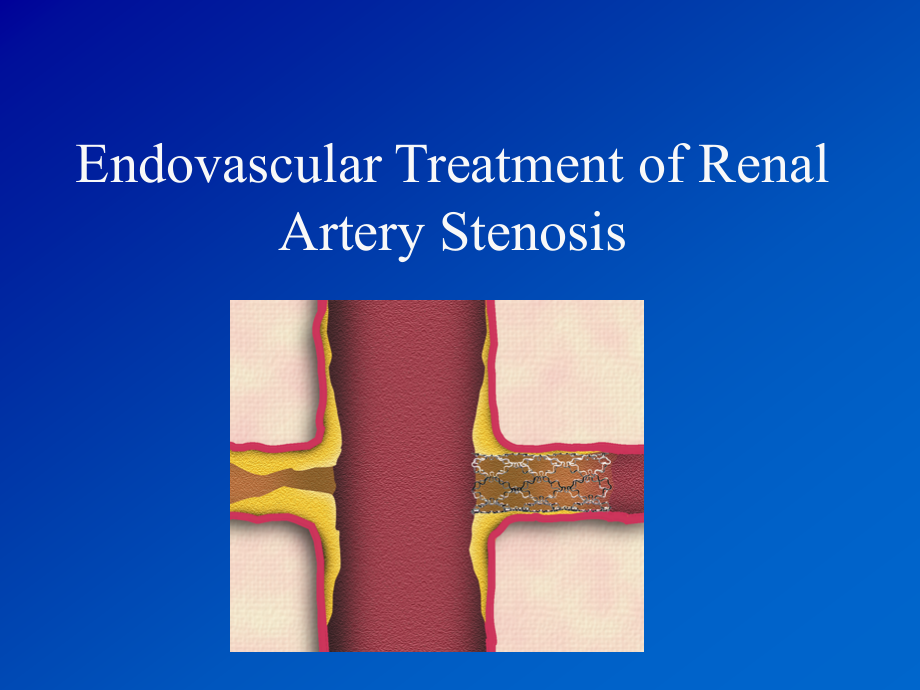肾动脉支架植入术图文详解-课件_第1页