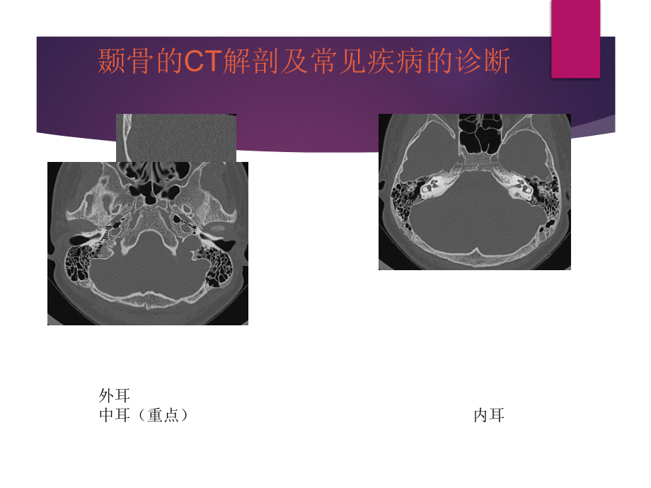 颞骨解剖及中耳炎CT诊断-课件_第1页