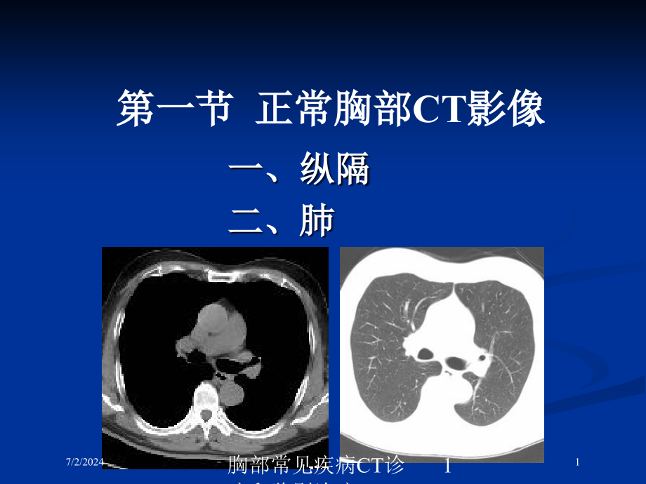 胸部常见疾病CT诊疗和鉴别诊疗培训ppt课件_第1页