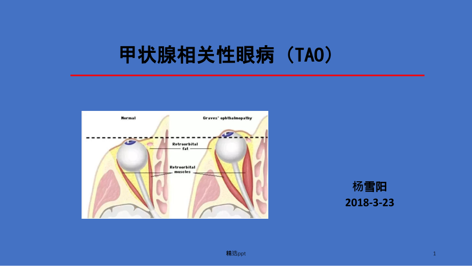 甲状腺相关性眼病课件_第1页