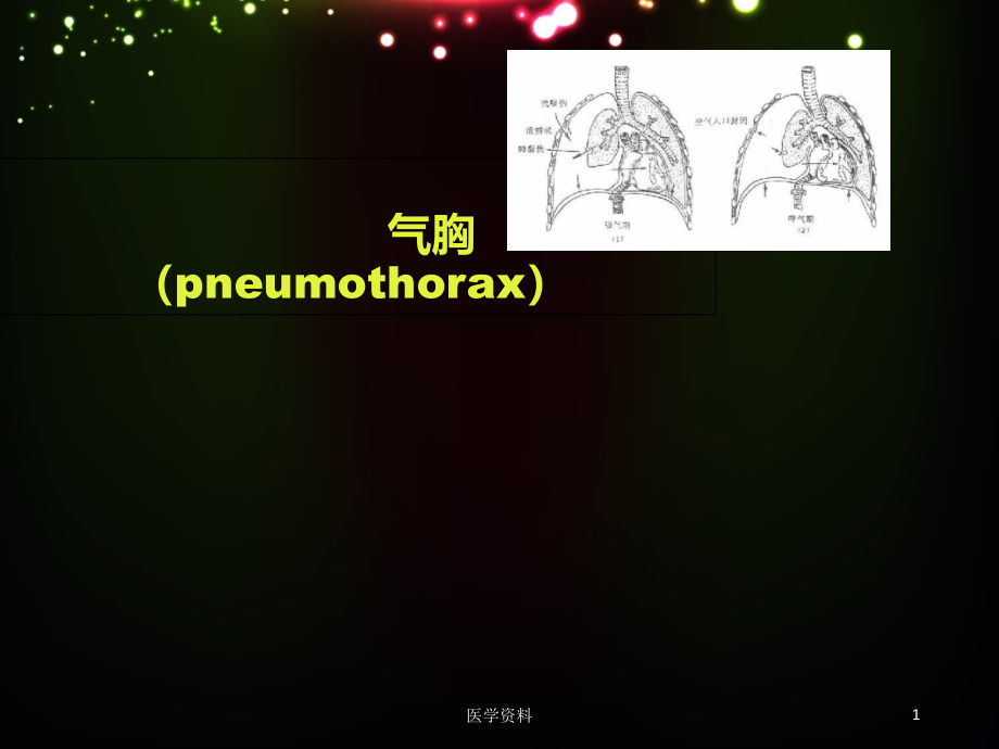 气胸-(呼吸内科)课件_第1页