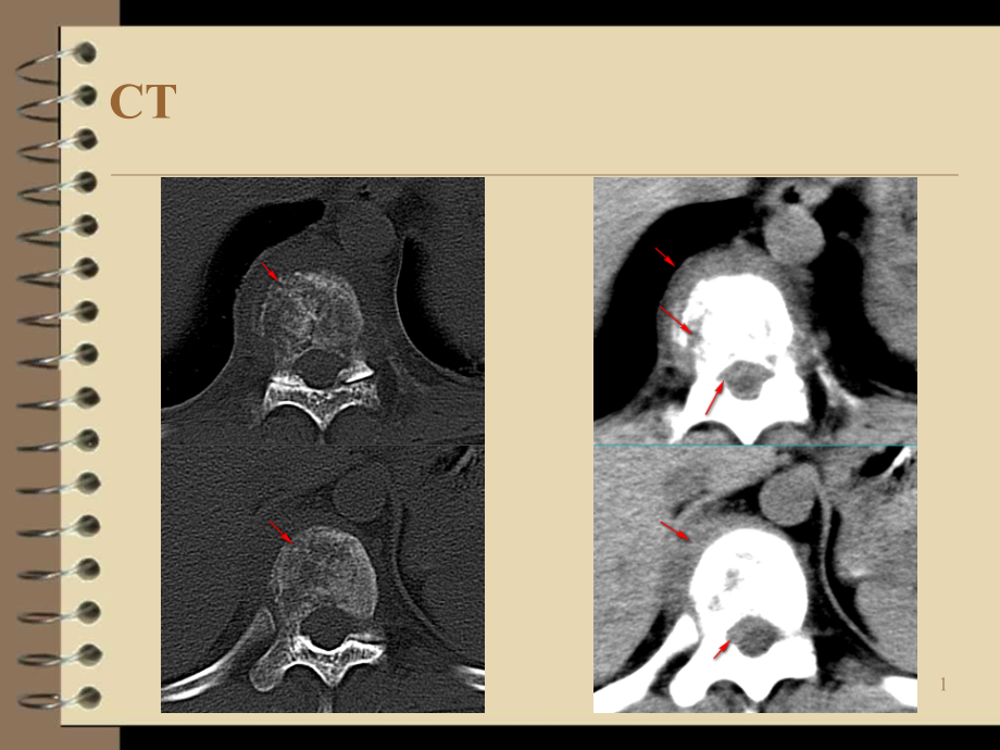 脊柱原发性恶性淋巴瘤的影像诊断课件_第1页