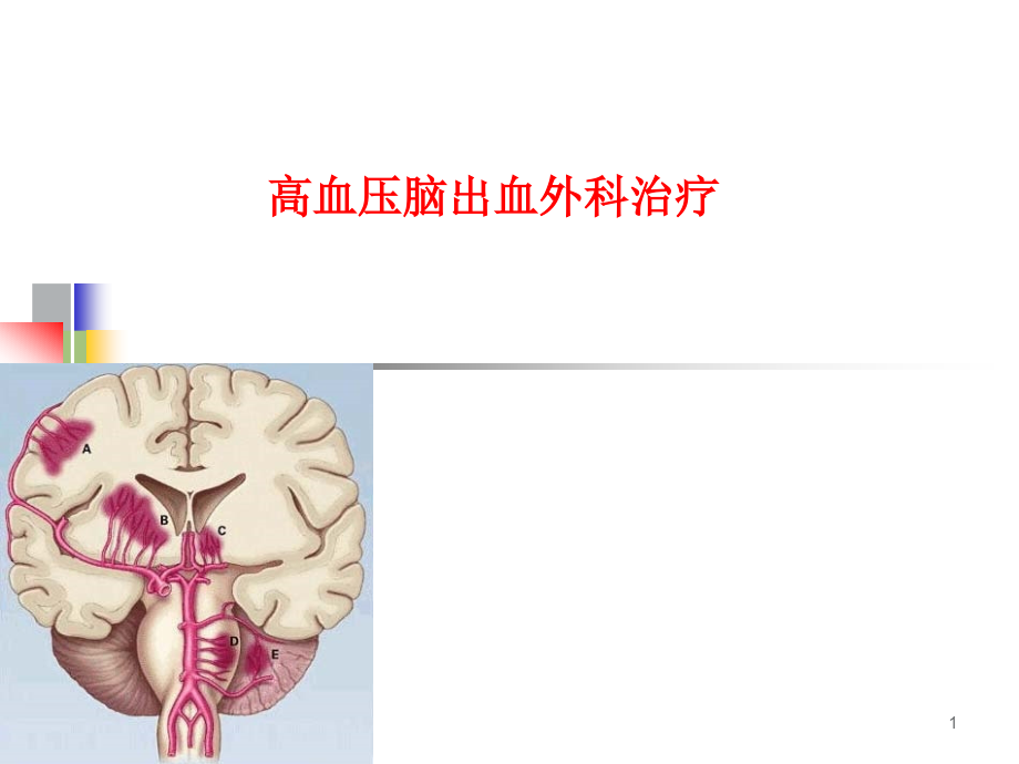 高血压脑出血的外科治疗课件_第1页